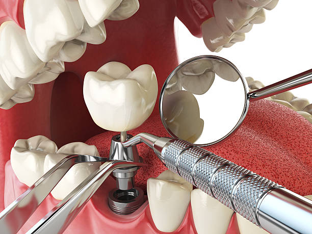 Best Emergency Root Canal Treatment in Narragansett Pier, RI